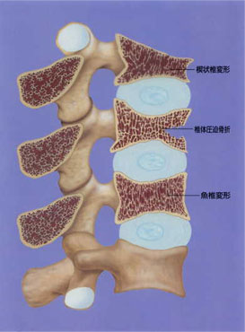 骨粗鬆症による圧迫骨折の図